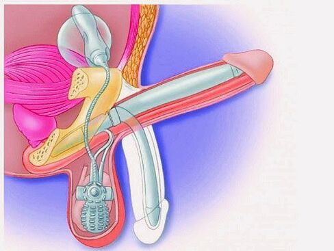 Penis enlargement with penile prosthesis